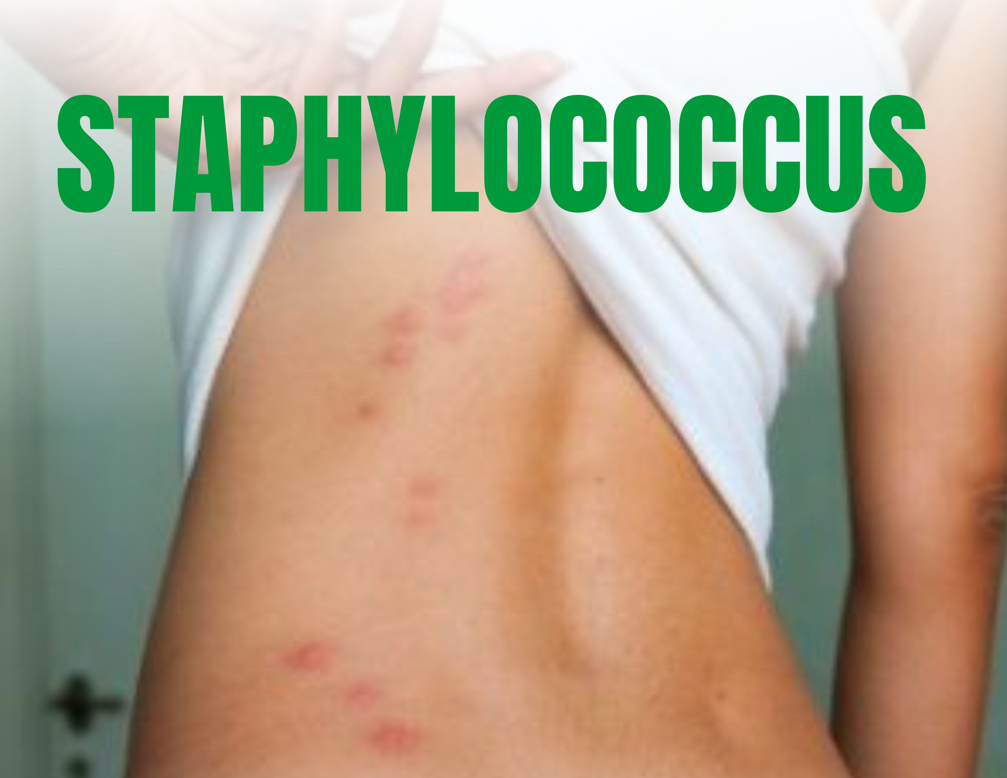 Staphylococcus 
